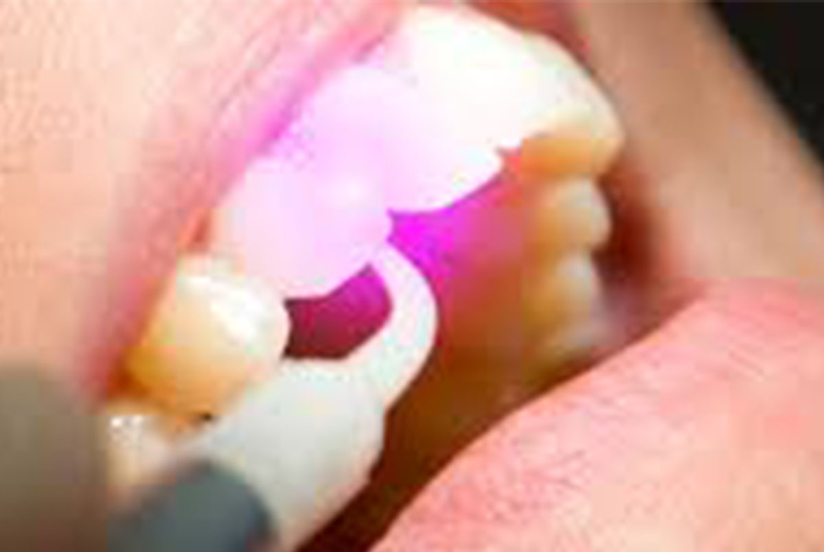 terapia laser lembo dental clinic